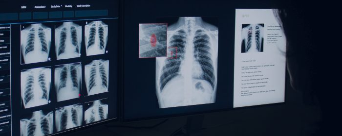 Qure.ai gets financial support to develop AI-based lung screening software