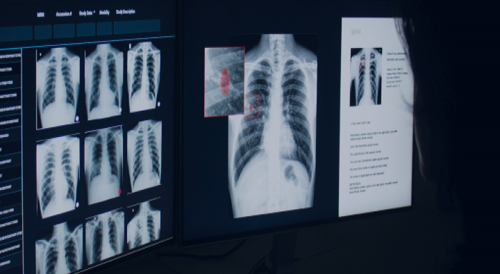 Qure.ai gets financial support to develop AI-based lung screening software
